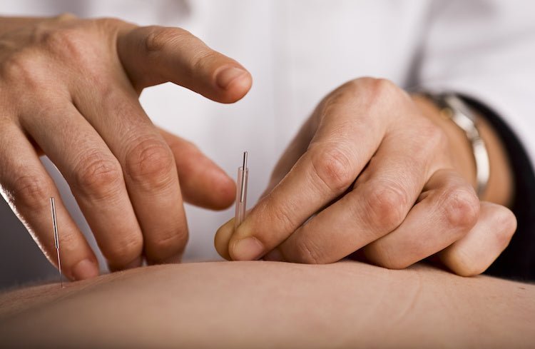 Can Acupuncture Improve Fertility? - Conceive Plus®